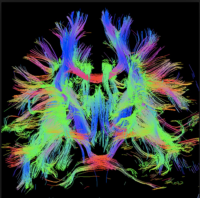 DTT med fremstilling af de nervebaner generelt i hjerne, farvekodet for retning