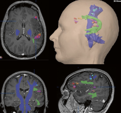 DTT med fremstilling af de Corticospinalebaner (lilla) og Fasciculus Arcuatus grøn, samt markering af essentielle sprog cortex områder baseret på fMRI