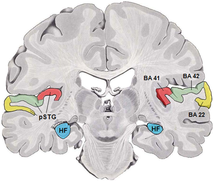 Fil:Human temporal lobe areas.png