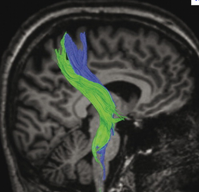 Tractus Cortico-Spinalis - NeuroWiki